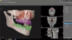 医療CT／MRI用DICOM 3Dコンバーター Geomagic D2P